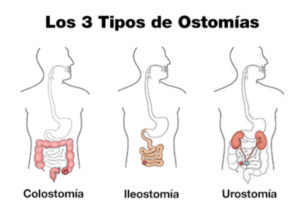 3 tipos de Ostomía